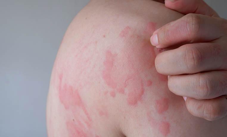 Urticaria aguda y crónica